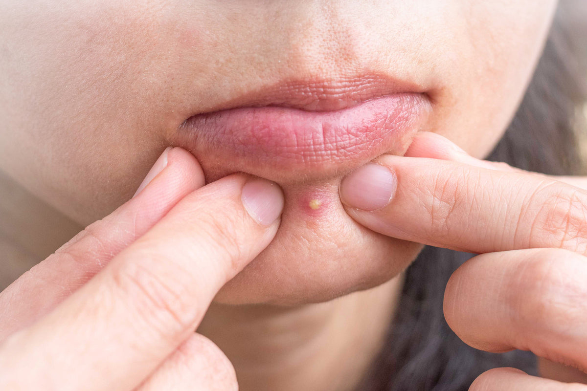 Acne vs. pimples: What’s the difference?